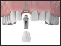 Dental implants
